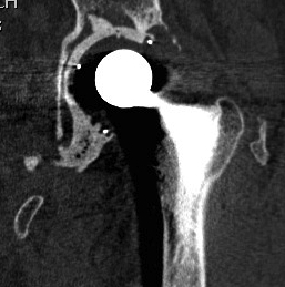 Revision THR Cemented Cup Anterior Wall Intact